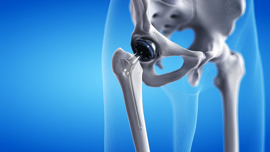 Is the 'Anterior Approach' Total Hip Replacement Better? - Tri