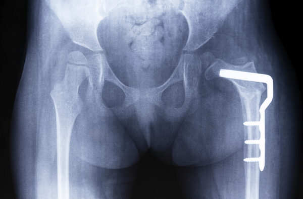 Periacetabular Osteotomy Arlington Va Nirschl Orthopaedic Center 5318